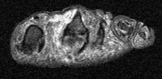 Figure 6 for case Plantar plate rupture